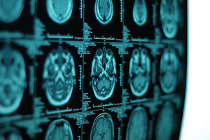 Brain Injury
