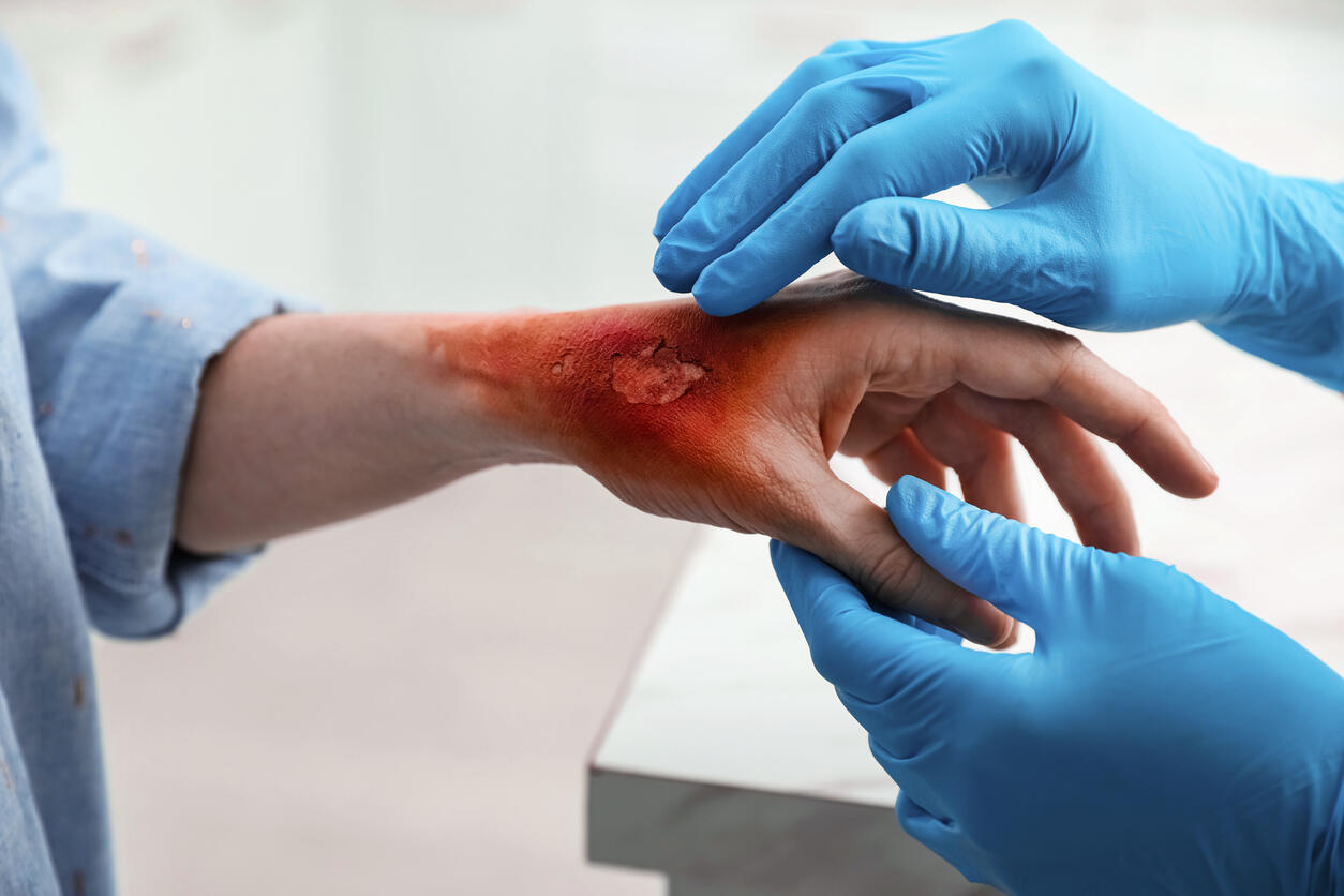 Burn Injuries Lead to Lifelong Medica